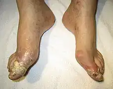 Goutte compliquée d'une rupture de tophus (exsudat contenant des cristaux d'urates de sodium).