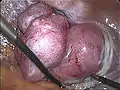 Extraction vaginale de l'utérus lors d'une hystérectomie laparoscopique totale