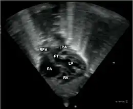 Description de l'image Transposition great arteries Orphanet 1750-1172-3-27-1.JPEG.