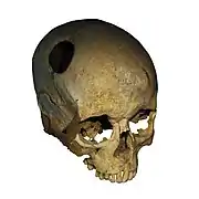 Crâne de femme trépanée vers 3500 av. J.-C., découvert à Corseaux, Canton de Vaud.