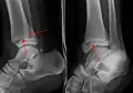 Une fracture triplane de la cheville vue sur une radiographie standard