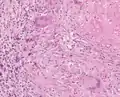Granulome tuberculoïde avec nécrose caséeuse (En haut à droite)