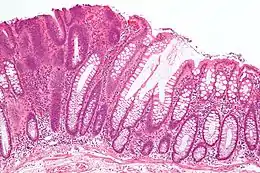 Lésions précancéreuses - Adénome tubulaire (à gauche de l'image), un type de polype du côlon et un précurseur du cancer colorectal (la muqueuse colorectale normale est visible à droite).