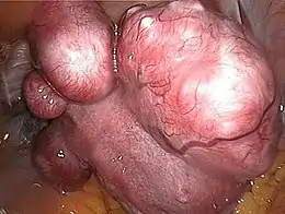 Description de l'image Uterine fibroids.jpg.