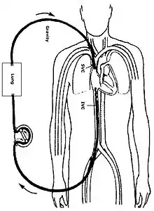 Schéma d'un corps humain et d'un circuit d'ECMO.