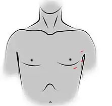 Dessin représentant un thorax et un cou, vus de face, avec le tracé des cicatrices des trocarts utilisés pour une thymectomie par vidéochirurgie.