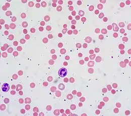 Description de l'image Warm autoimmune hemolytic anemia.jpg.