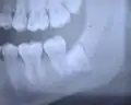 Radiographie de dents saines (prémolaires, molaires, dent de sagesse incluse) et cariées (2e prémolaire supérieure et 1re molaire supérieure).