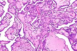 cellules de mésothéliome.