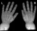 Radiographie de mains et poignets.