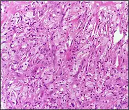 Description de l'image Xanthoma10X.jpg.