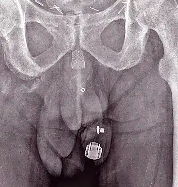 Radiographie d'un ZSI 375 implanté. Le dispositif est désactivé: le ressort est sous le sommet du cylindre. Le patient est incontinent.