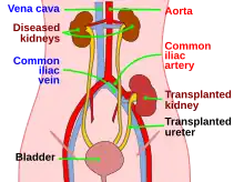 Description de l'image kidtransplant.svg.