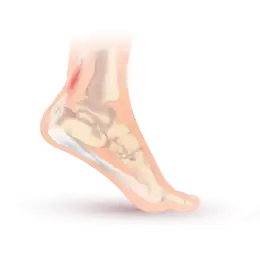 Description de l'image Achilles tendonitis.svg.