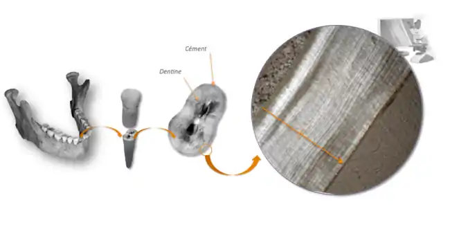 Principe de la cémentochronologie. Sélection et extraction d'une dent, coupe transversale de la racine et observation du cément en microscopie optique à lumière transmise.